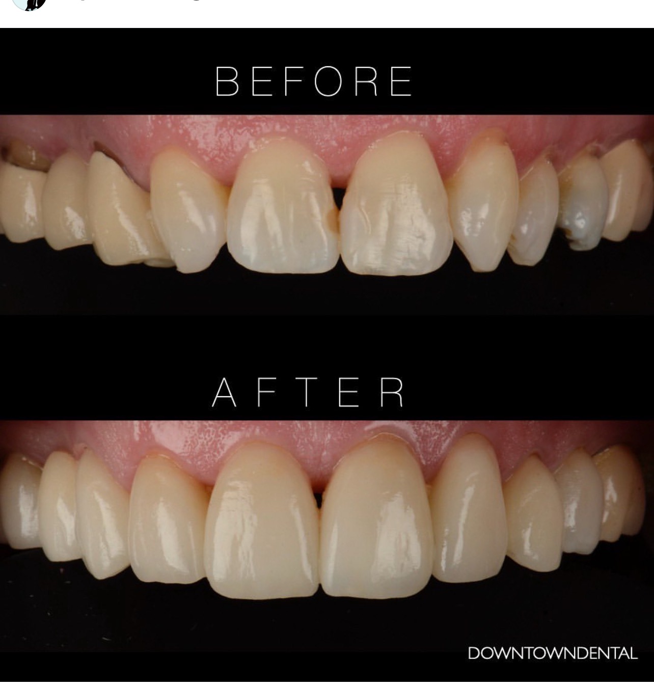 All-Ceramic Restoration